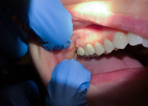 Best Emergency Treatment for Dental Infections or Abscesses in Kirkwood, MO